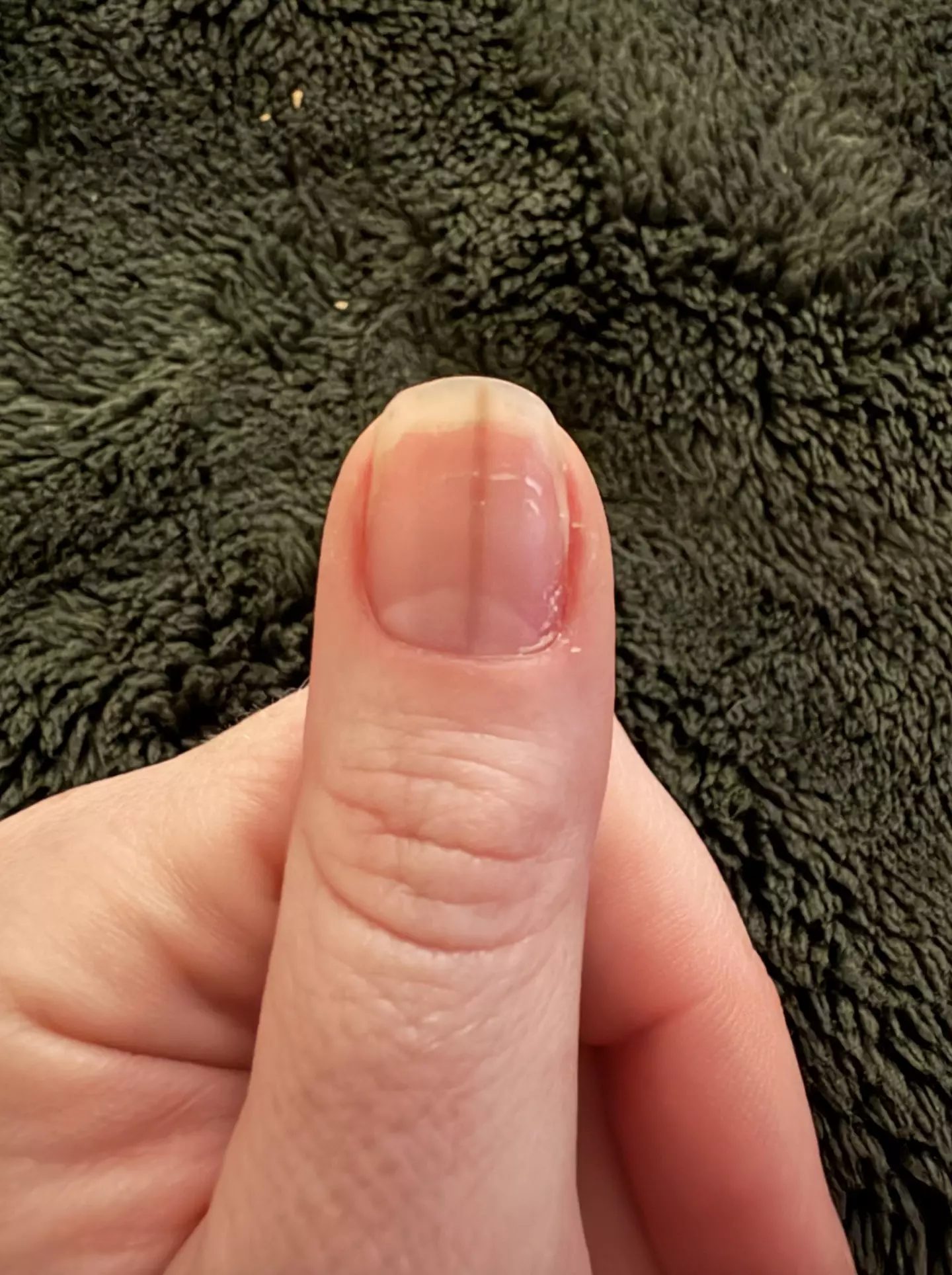 The Redditor posted a photo of her fingernail (Reddit/Tough_nips)