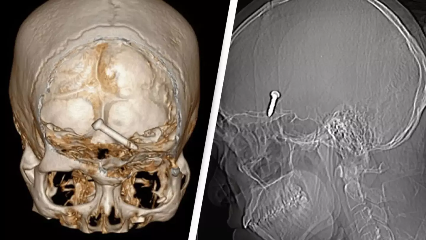 Surgeons remove 3cm nail lodged in man’s brain after accidentally firing nail gun through eye