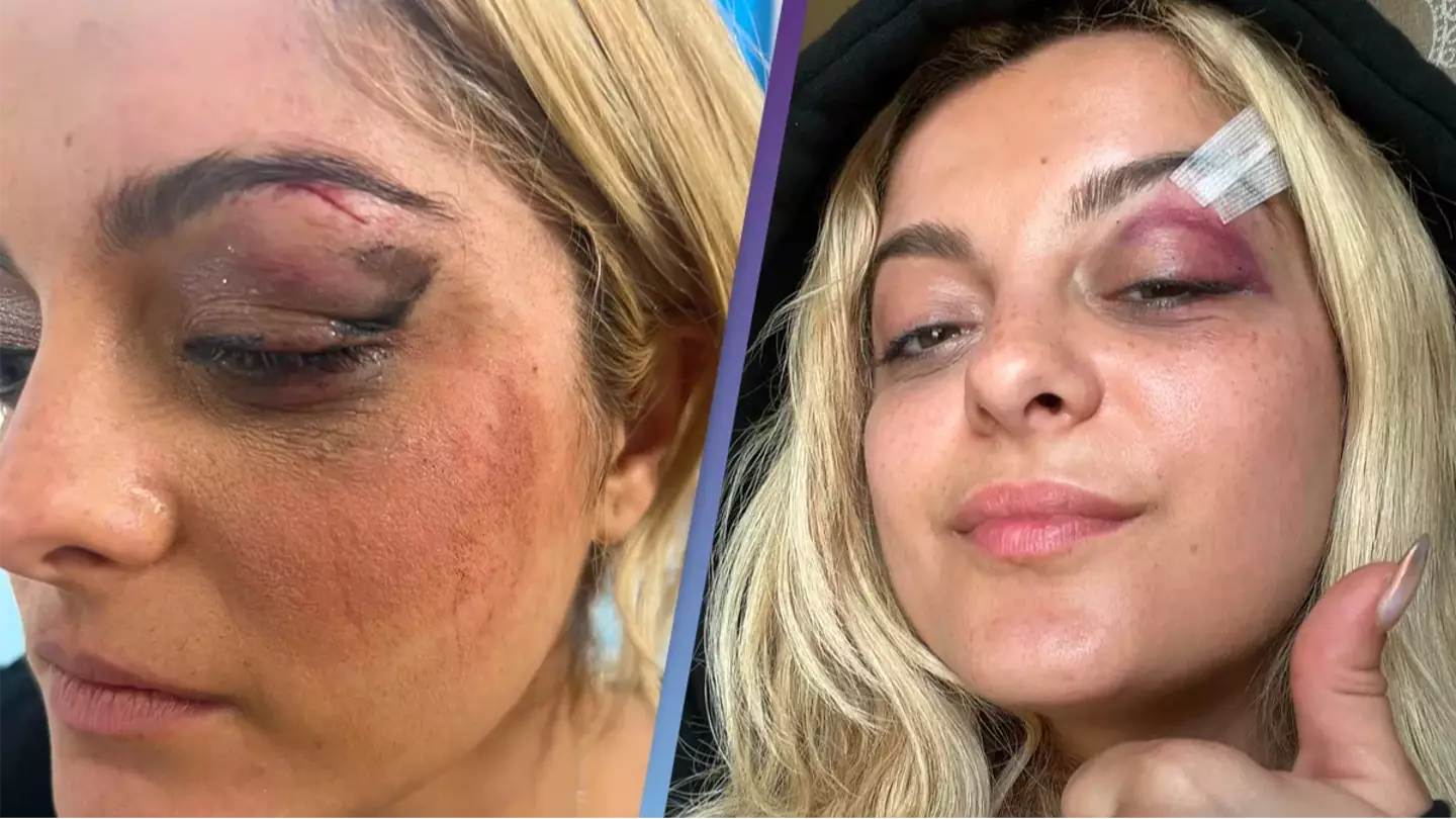 Bebe Rexha posts picture of her injuries as she breaks silence after phone attack