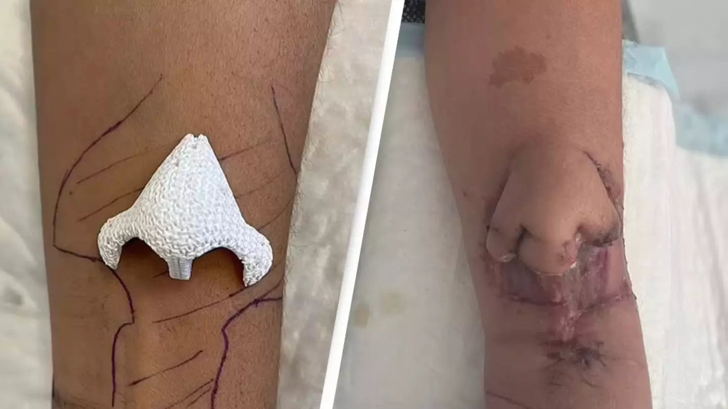 Woman grows new nose on her arm after battling cancer