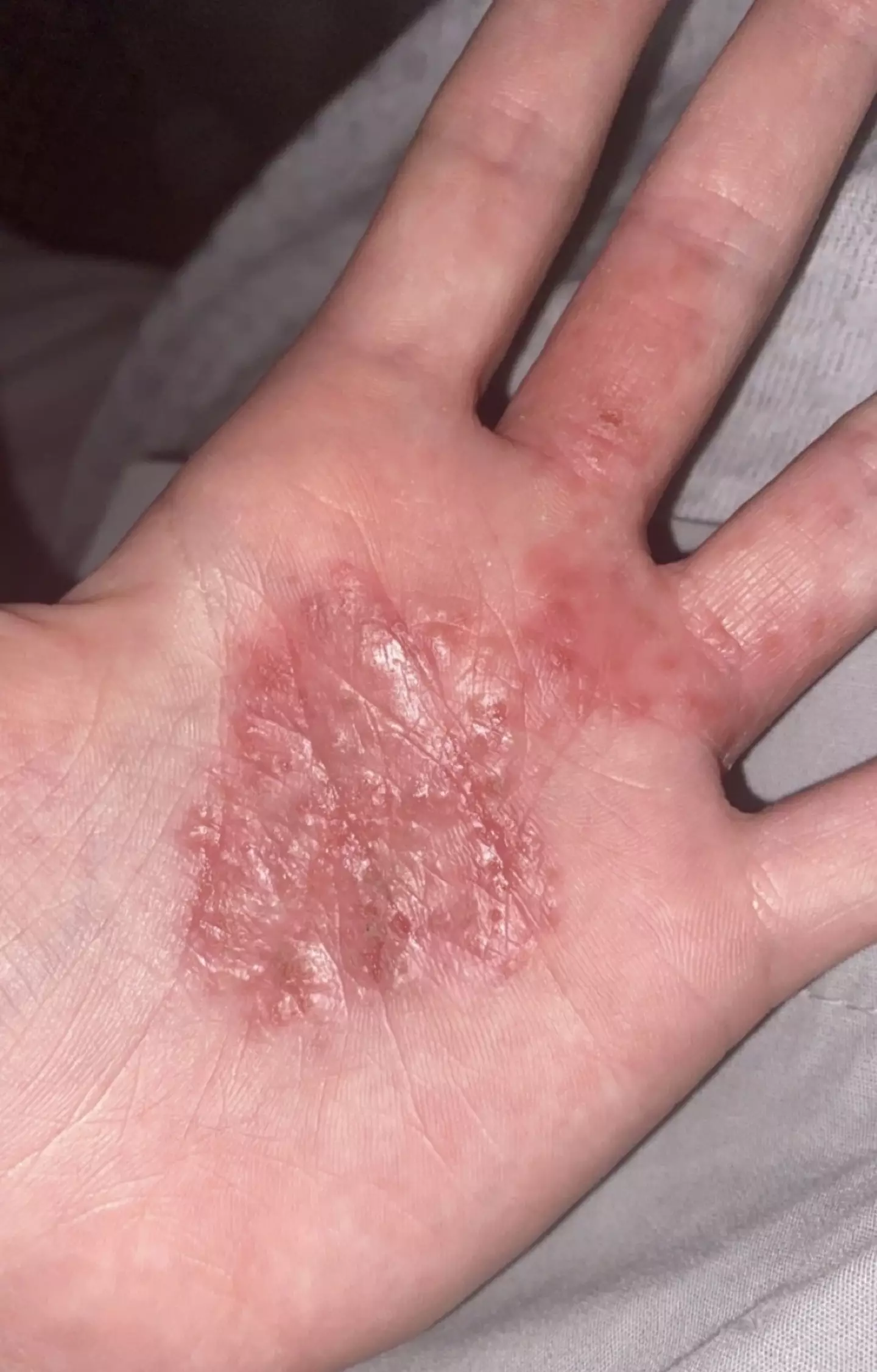 Darice's condition leaves her with blisters on her hands (Kennedy News)