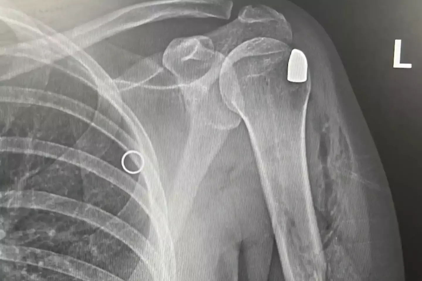 The bullet was left lodged in her shoulder.