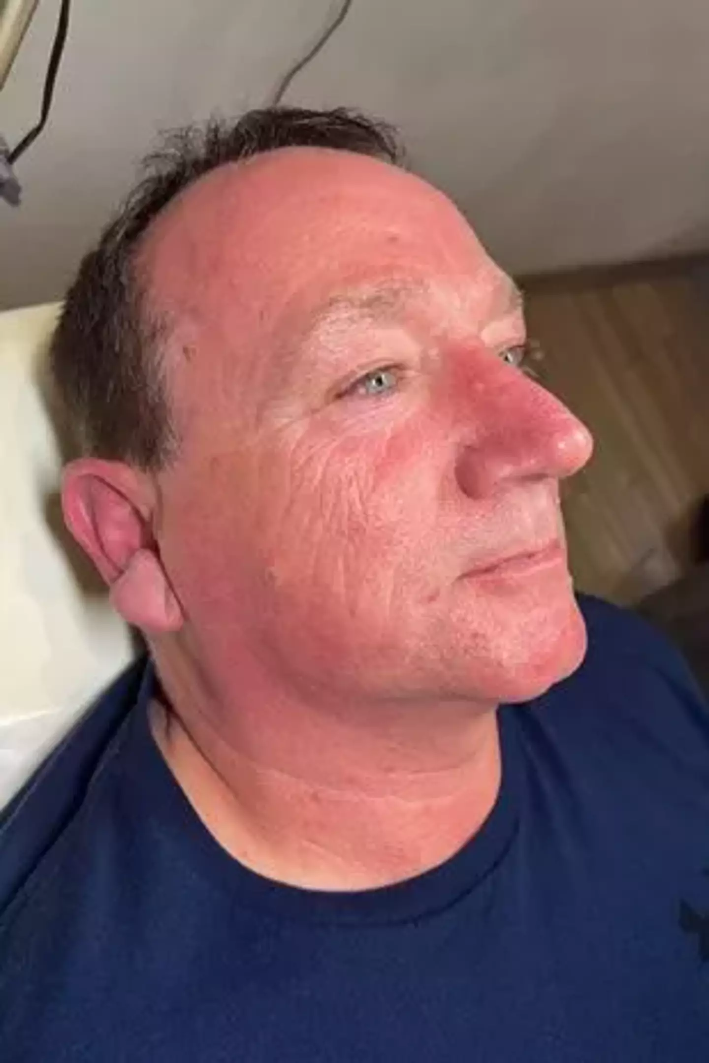 Steve has never worn suncream.