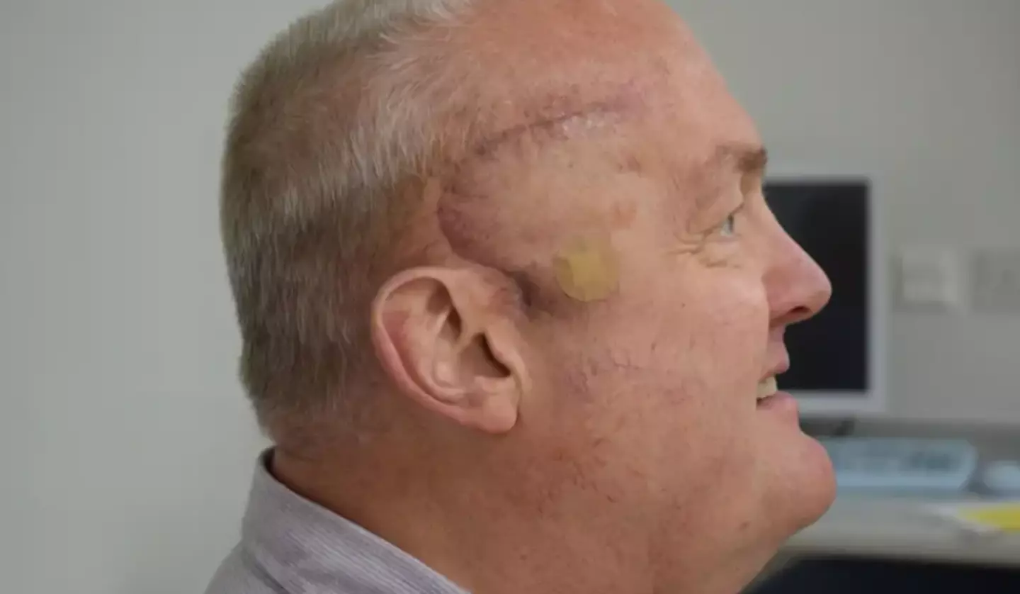 His tumor shrank by 50 percent (University College London Hospitals NHS Foundation Trust)