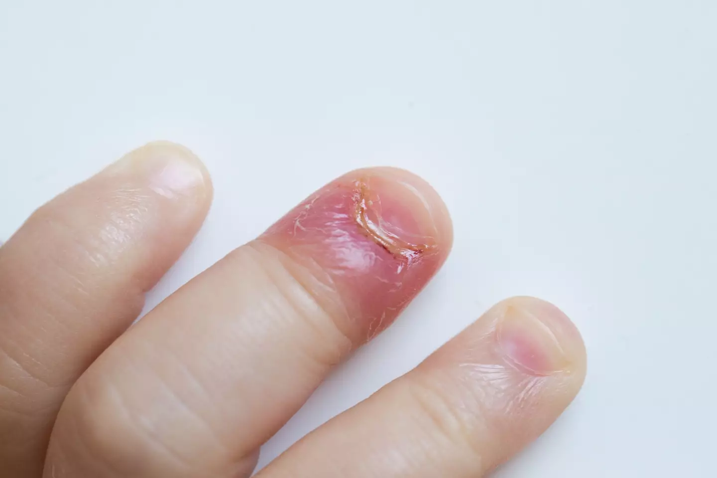 Paronychia is the name for the infection you can get around your fingernails if you bite them (Getty stock)