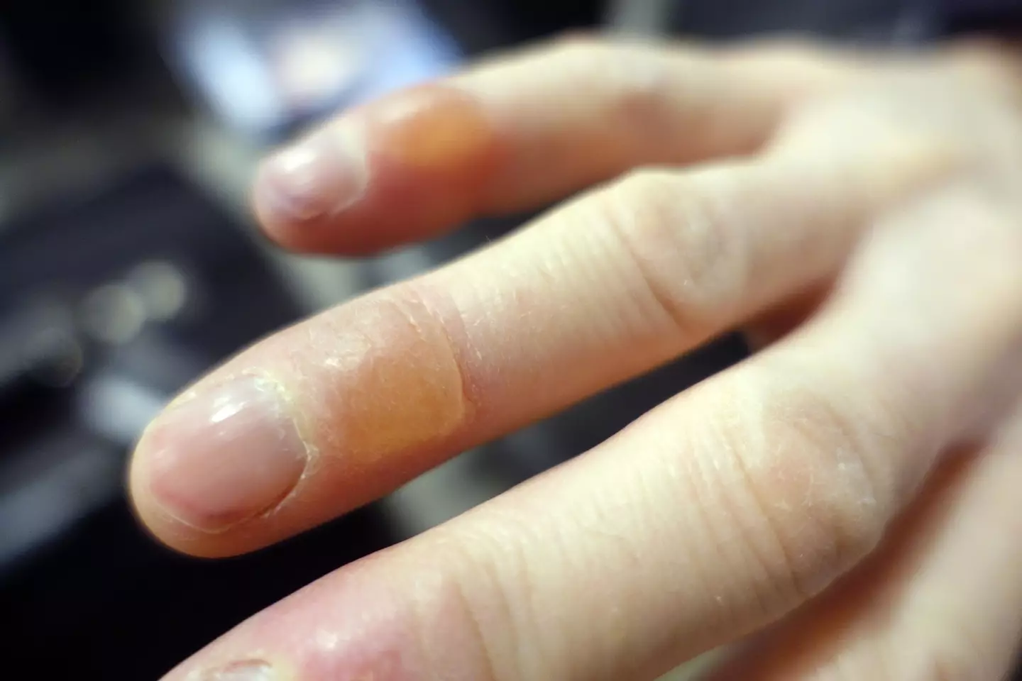 Experts have warned the extreme cold cause frostbite very quickly.