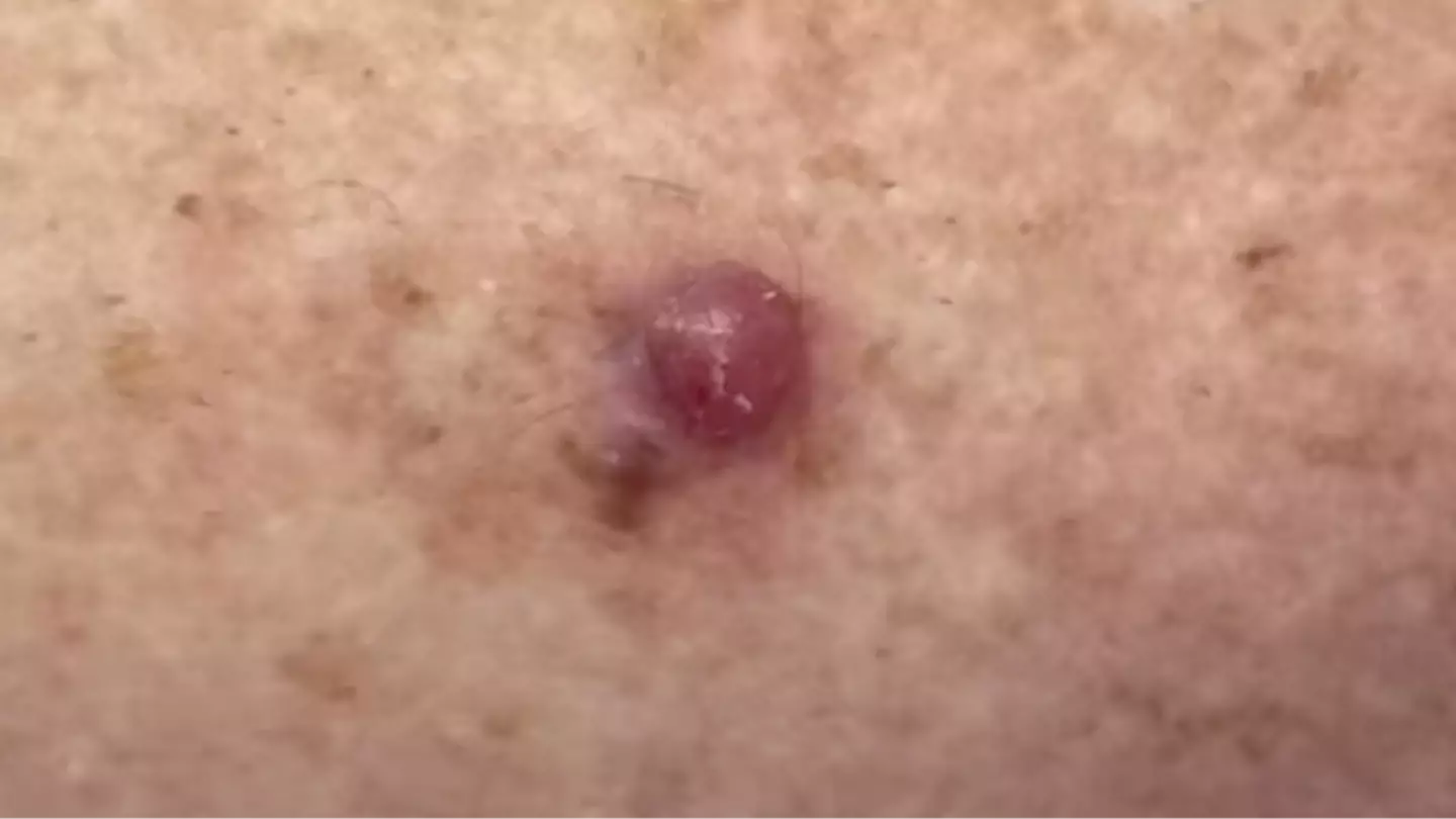 Signs of deadly skin cancer after doctor shares shocking video of 'worst melanoma’ he's ever seen