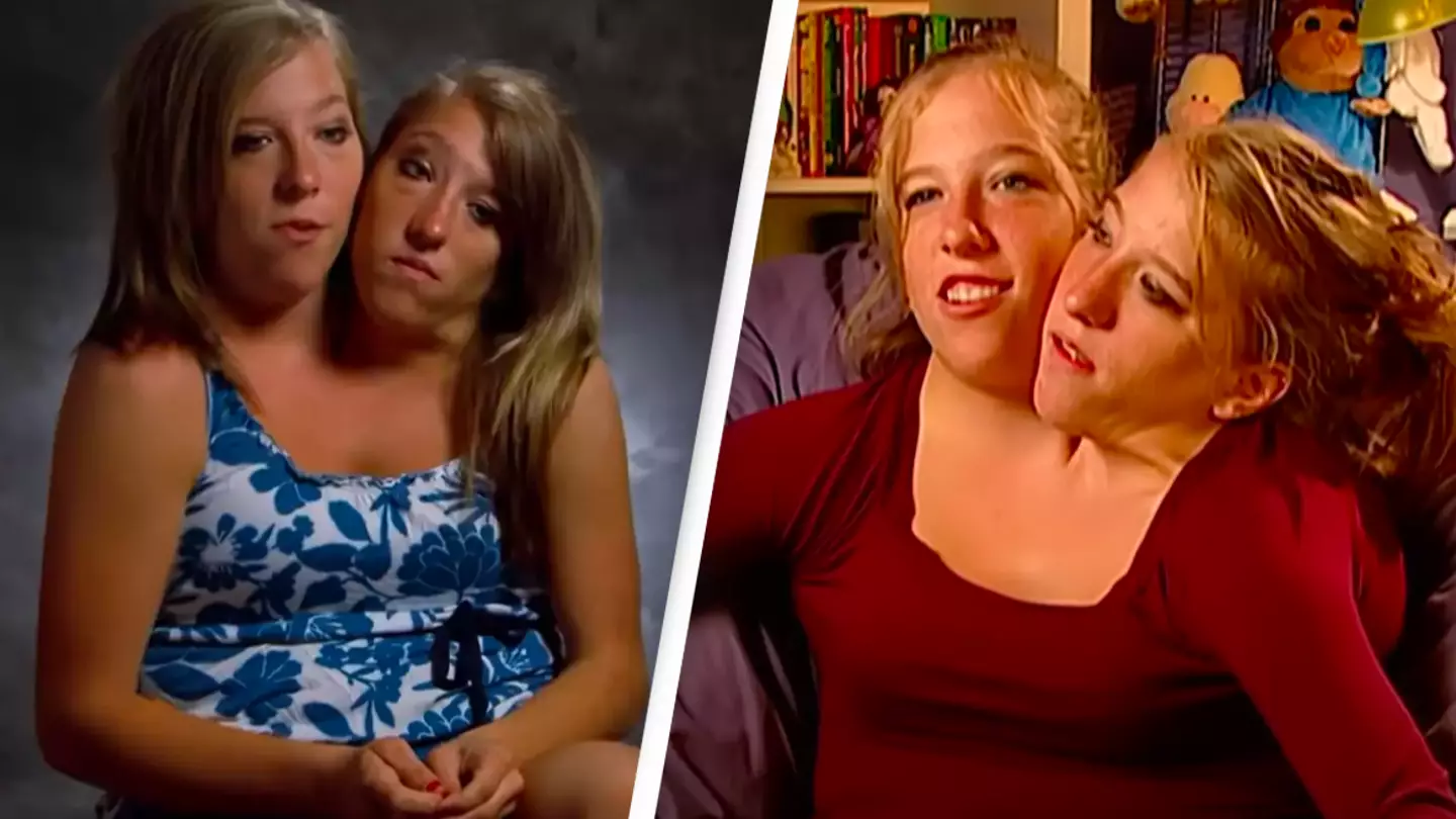 Conjoined twins' parents explain why they decided against separating them
