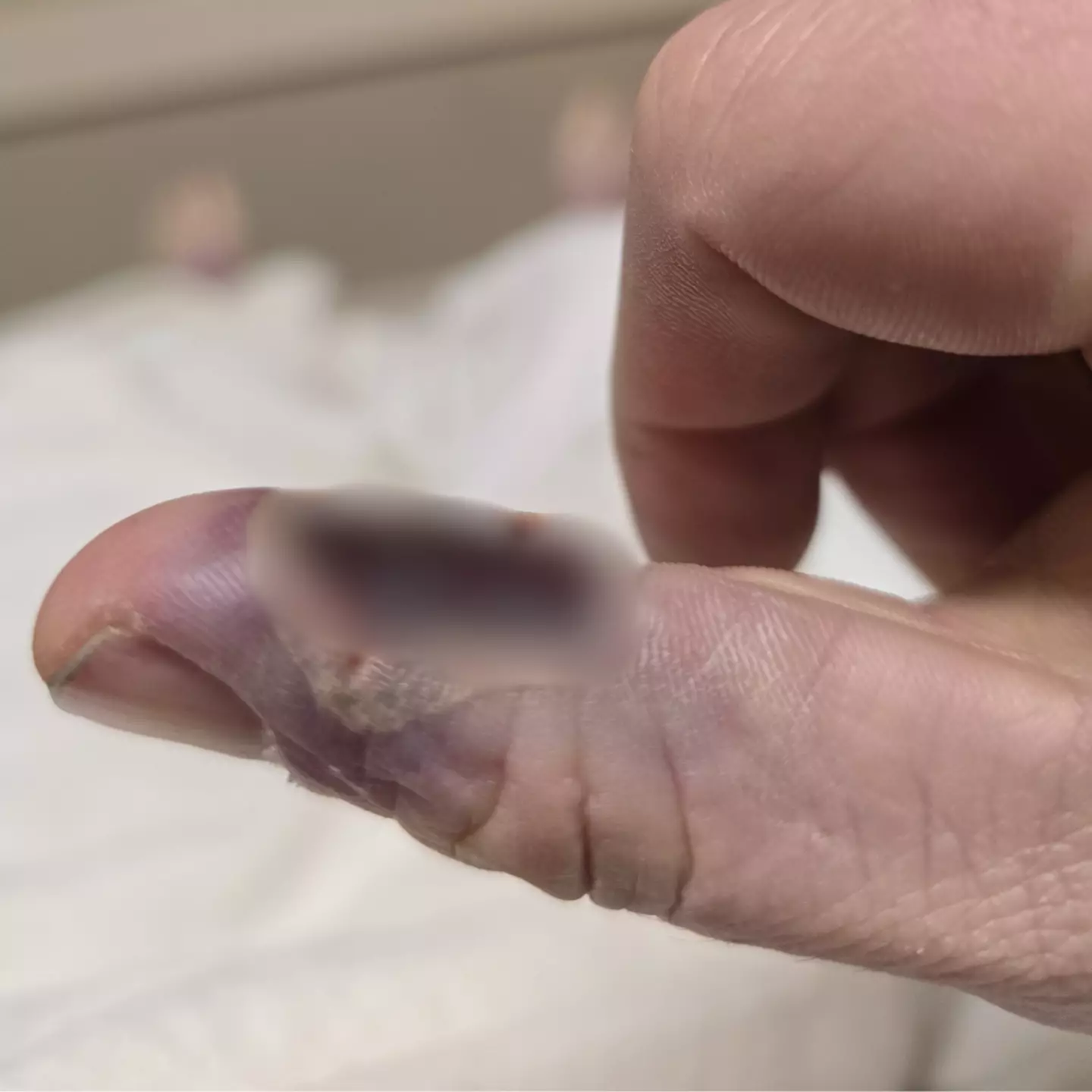 The burn to Max's thumb led to sepsis and a bilateral amputation (Max Armstrong / SWNS)