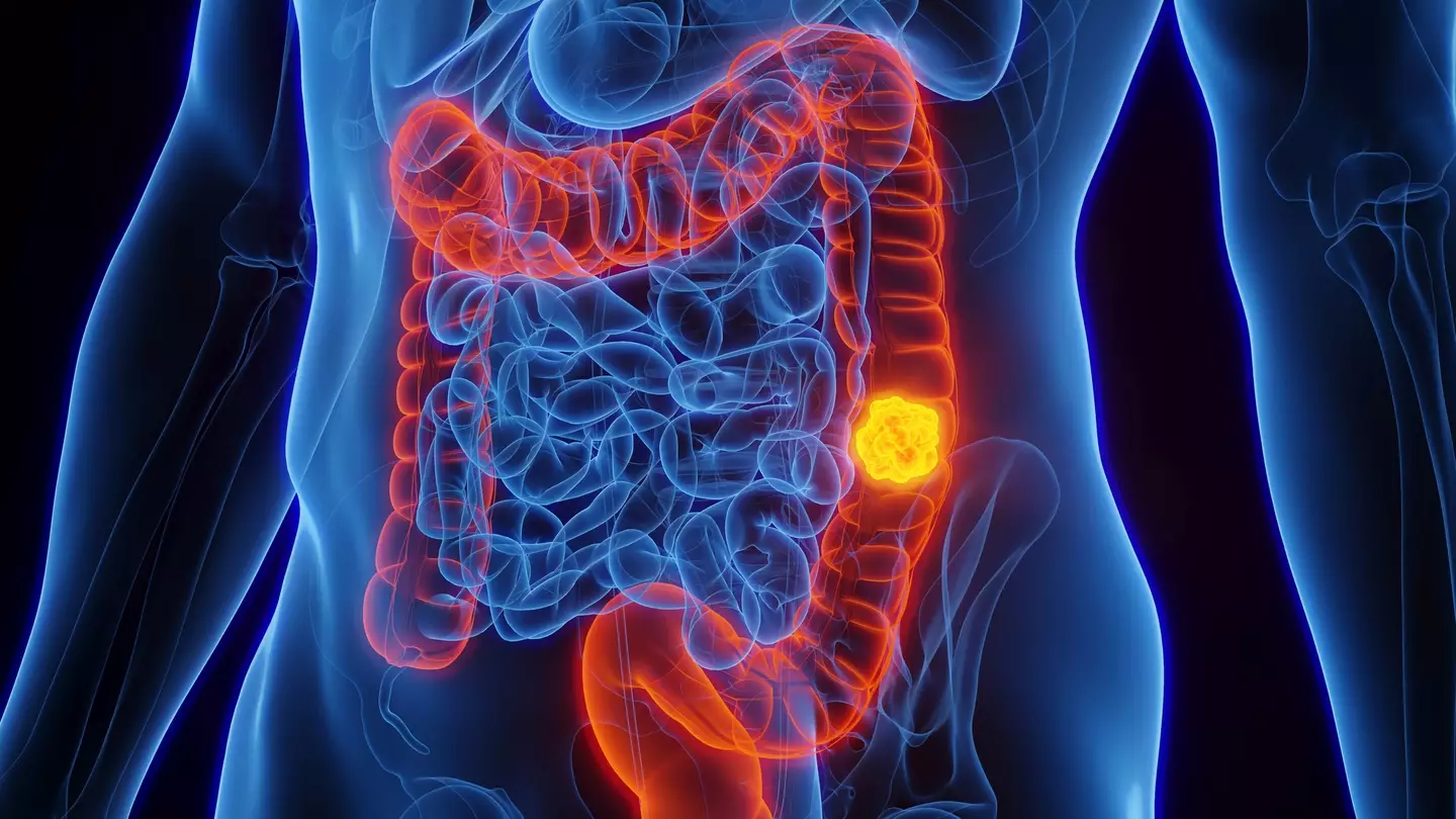 There are around 44,100 cases of bowel cancer every year in the UK (Getty Stock)