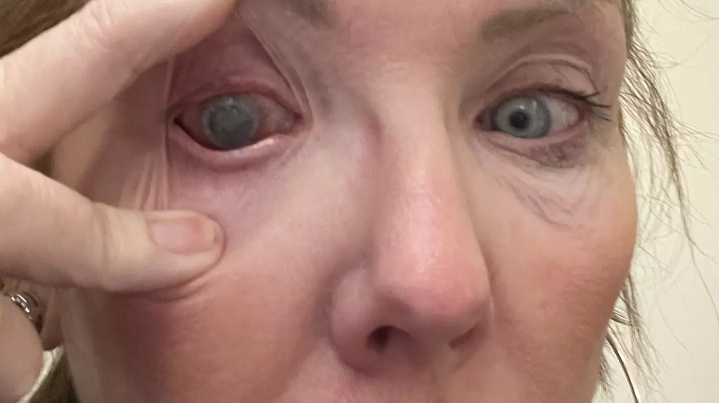 Woman left 'almost completely blind' in one eye after making common contact lens mistake