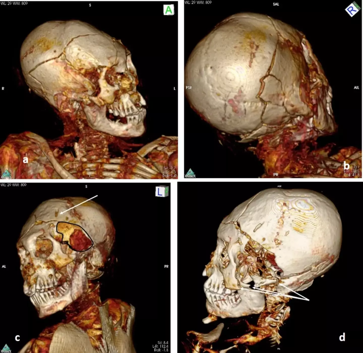 A 3D scan of the Delemont mummy also shows head trauma.