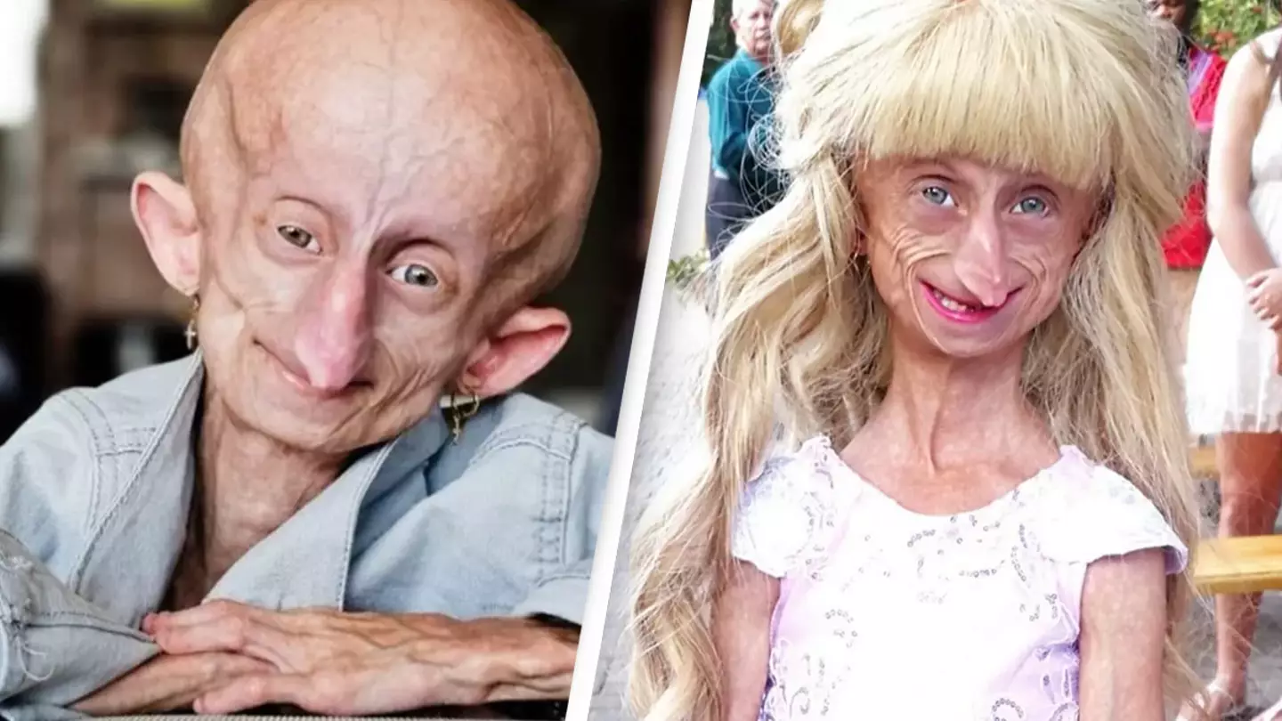 Teenage girl diagnosed with rare condition dies at 19 with the bodily age of 152 years old