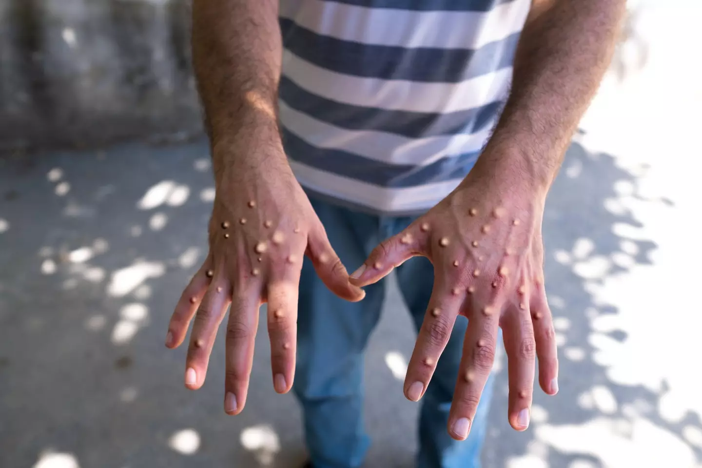 Man with blisters on his hands from monkeypox.
