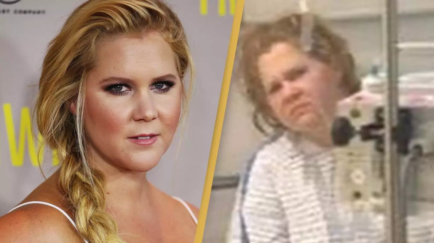 Amy Schumer shares before-and-after photos as a warning to 20 year olds