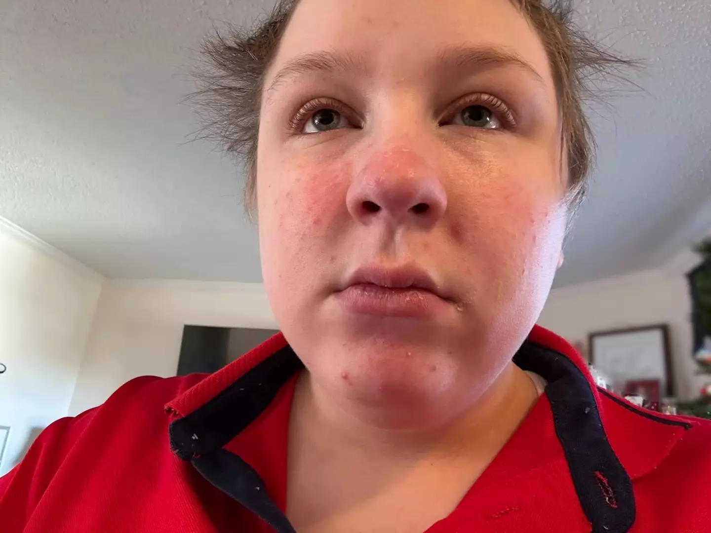 Izabella's skin comes out in a rash if she is exposed to the sun (Kennedy News and Media)