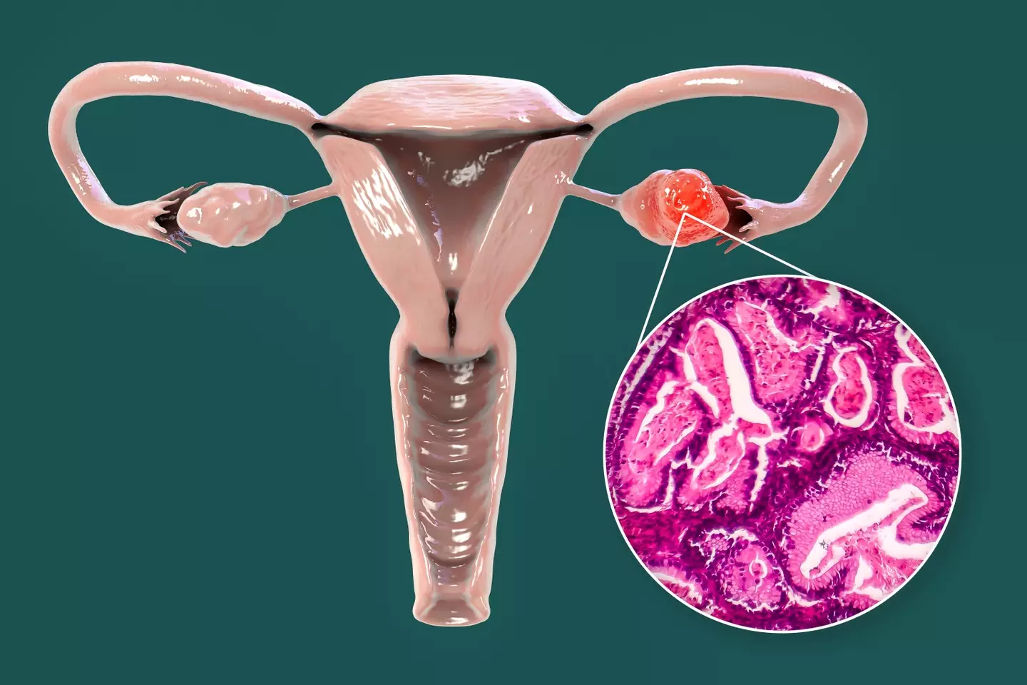 Ovarian cancer impacts thousands in the US (Getty Stock Photo)