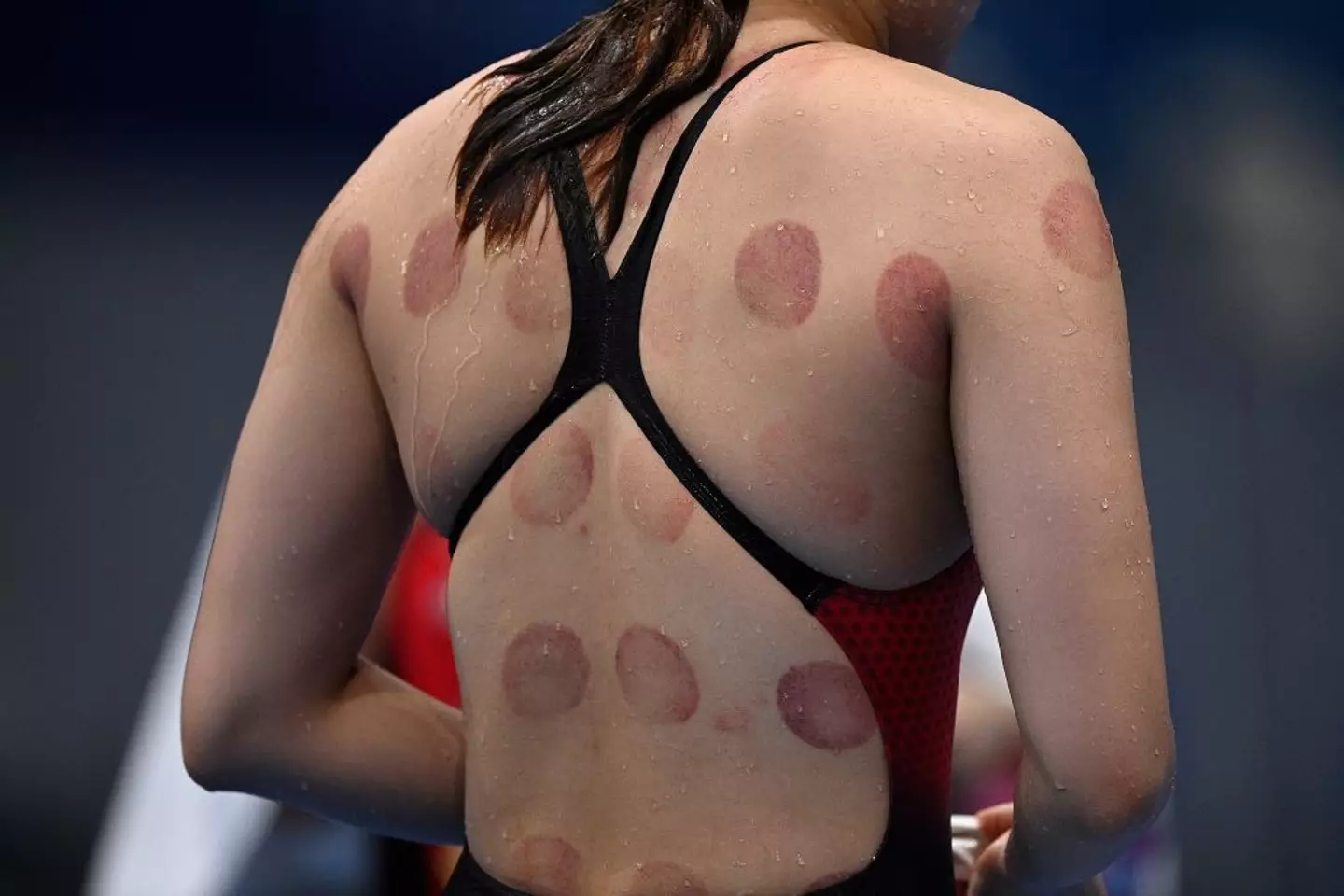 Swimmer pictured at Tokyo 2020 with circular bruising. (OLI SCARFF/AFP via Getty Images)