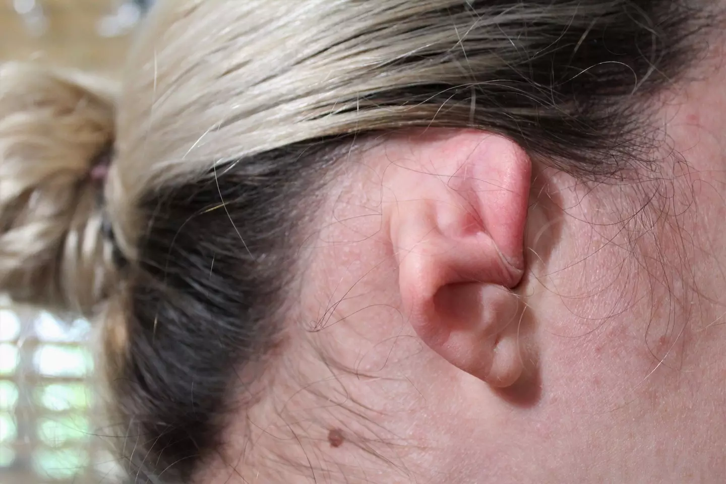 Microtia causes the external part of the ear to be tiny (stock image).