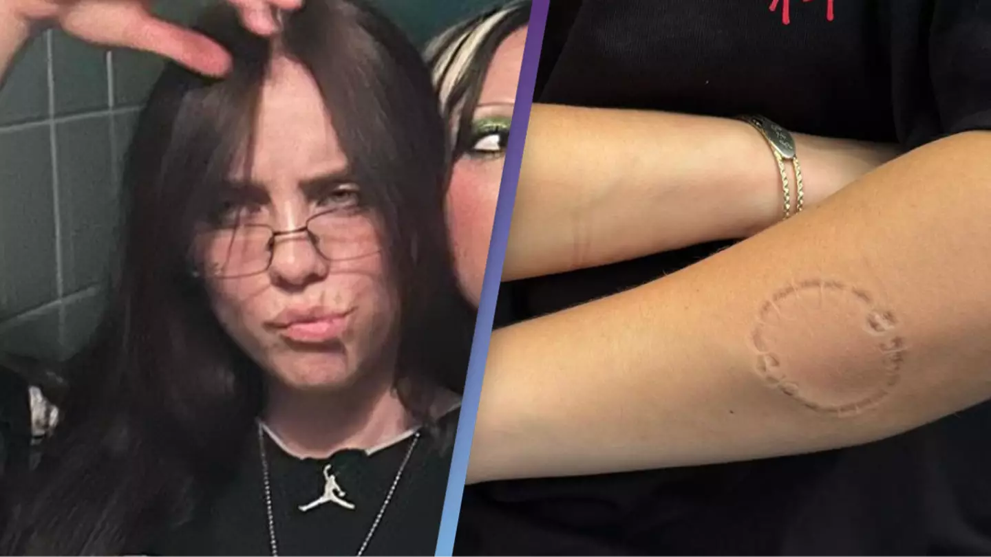 Billie Eilish sparks concern as she shares photo of bite marks on her arms