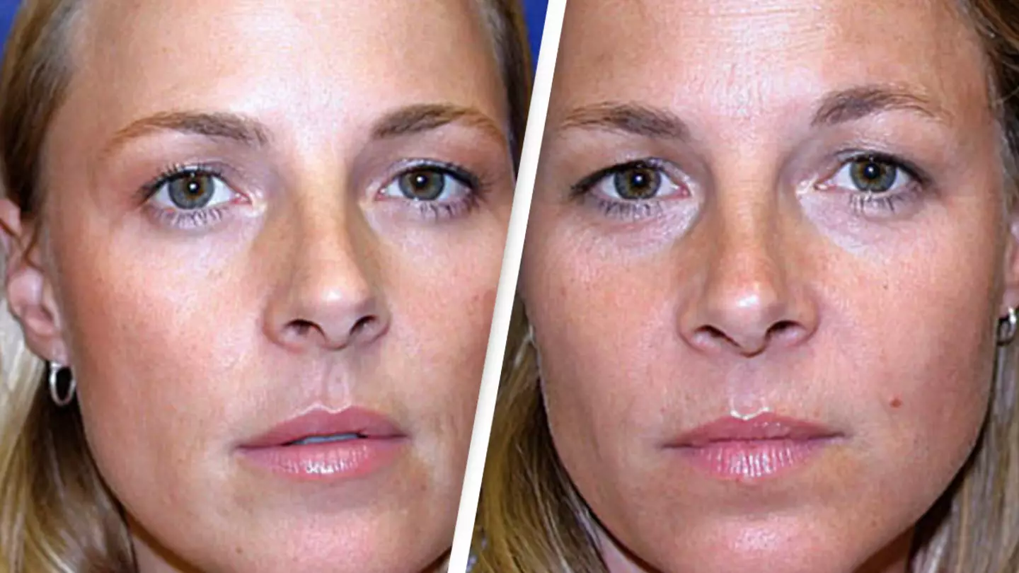 Identical twins share startling results after one used botox for 20 years while the other didn't