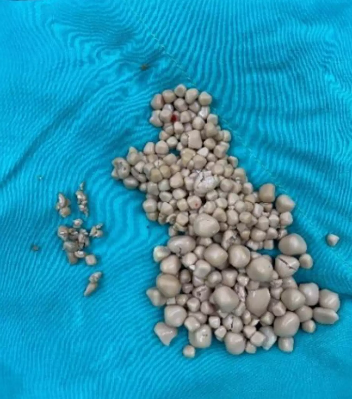 The kidney stones were likened to little 'steamed buns' (Chi Mei Medical Center)