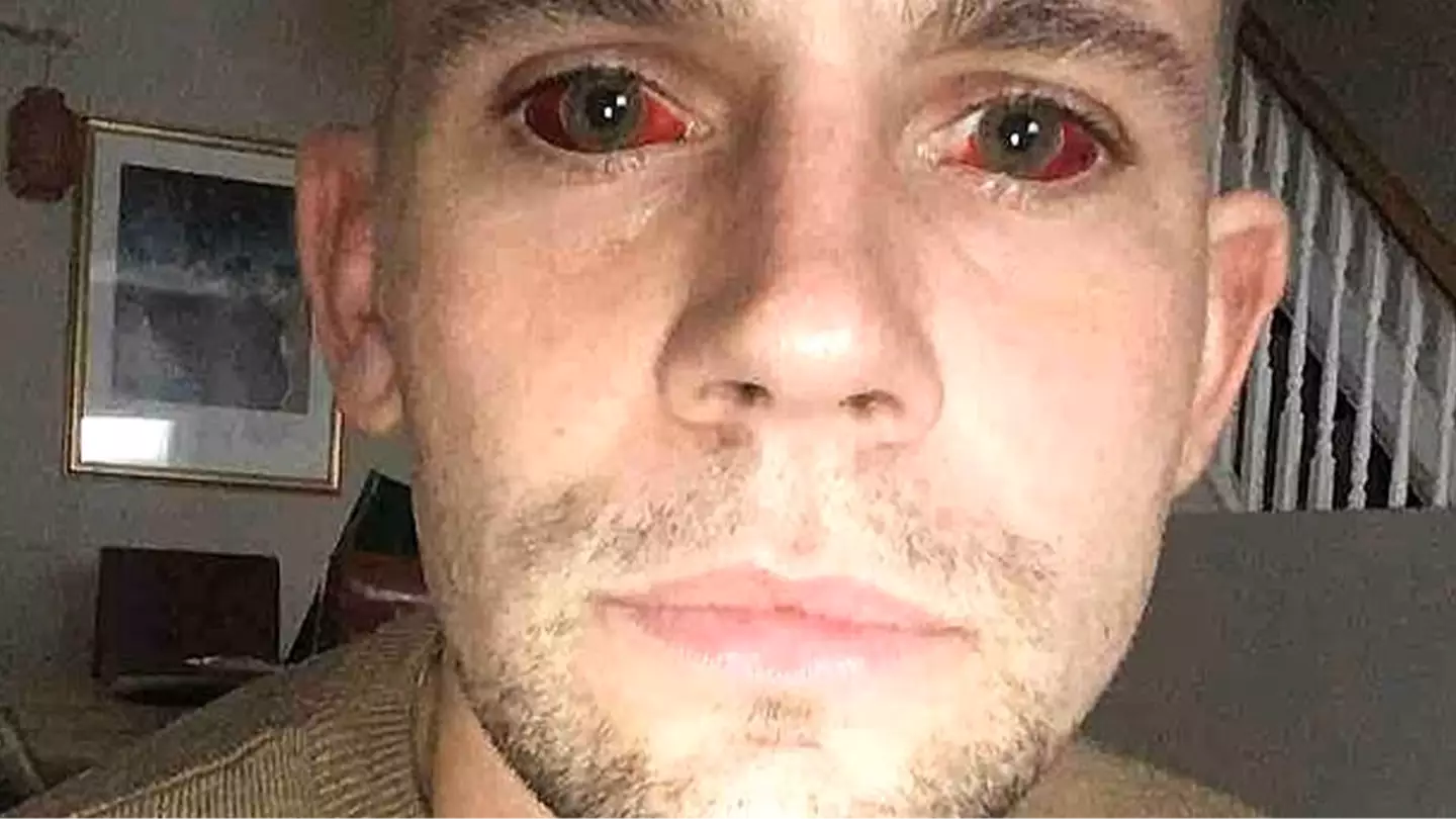 Man issues warning after five-day cocaine binge left him with 'devil eyes' and it almost killed him