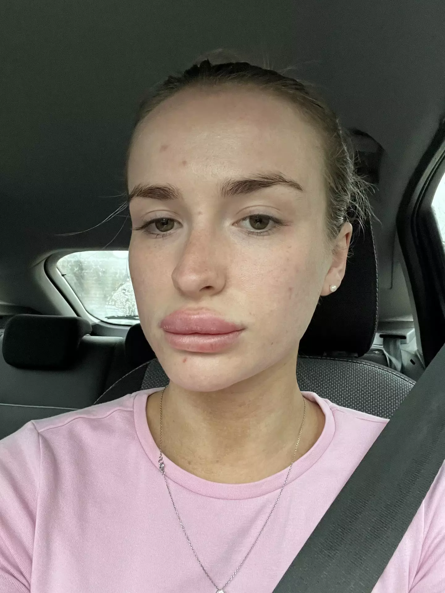 Lily Thompstone woke up with swollen lips (Kennedy News and Media)