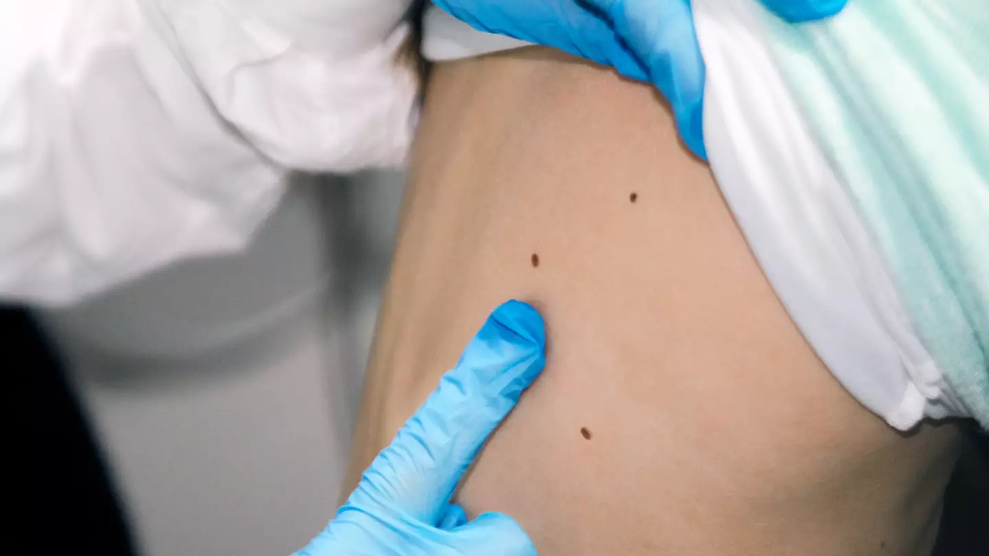 Experts reveal subtle signs of marks on your skin that could mean you have deadly cancer