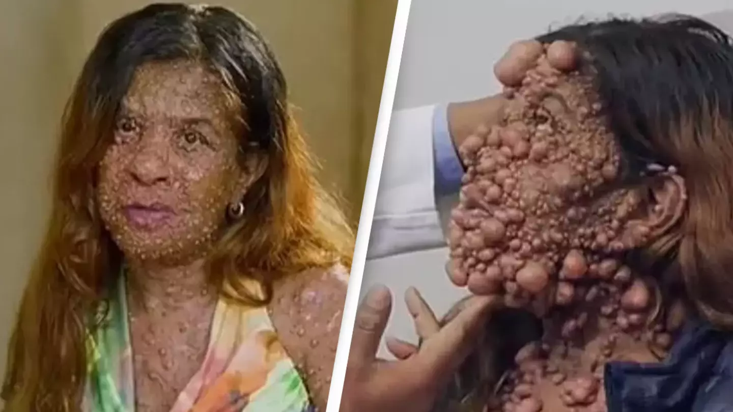 Woman with ‘one-of-a-kind’ condition can finally see her own face again after more than 60 hours of surgery