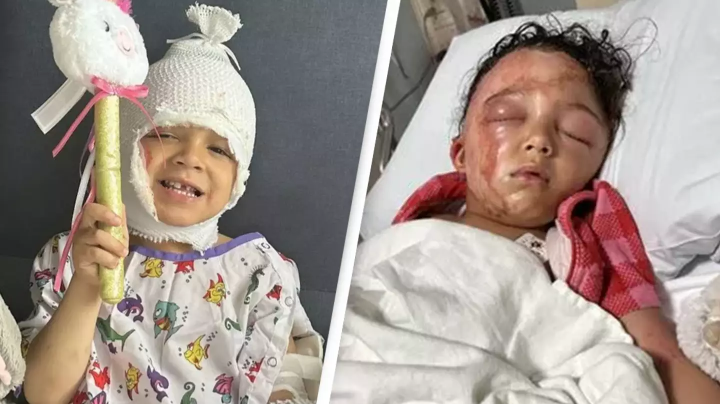 Mom gives critical warning to parents after child's face 'melts off' in horrific accident