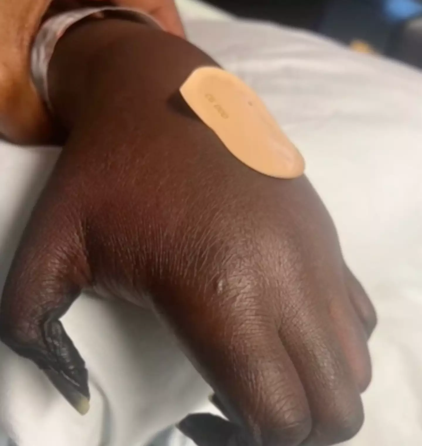 Deesh's finger tips turned black (BBC News)