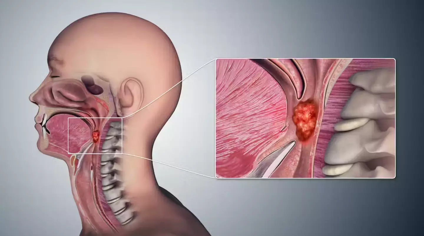 A scientist has revealed that oral sex is now the main cause of throat cancer.