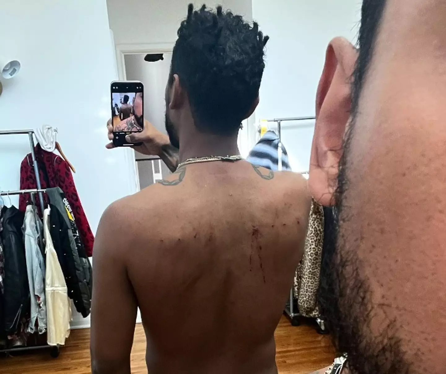 The singer showed the damage the hooks had done to his back.