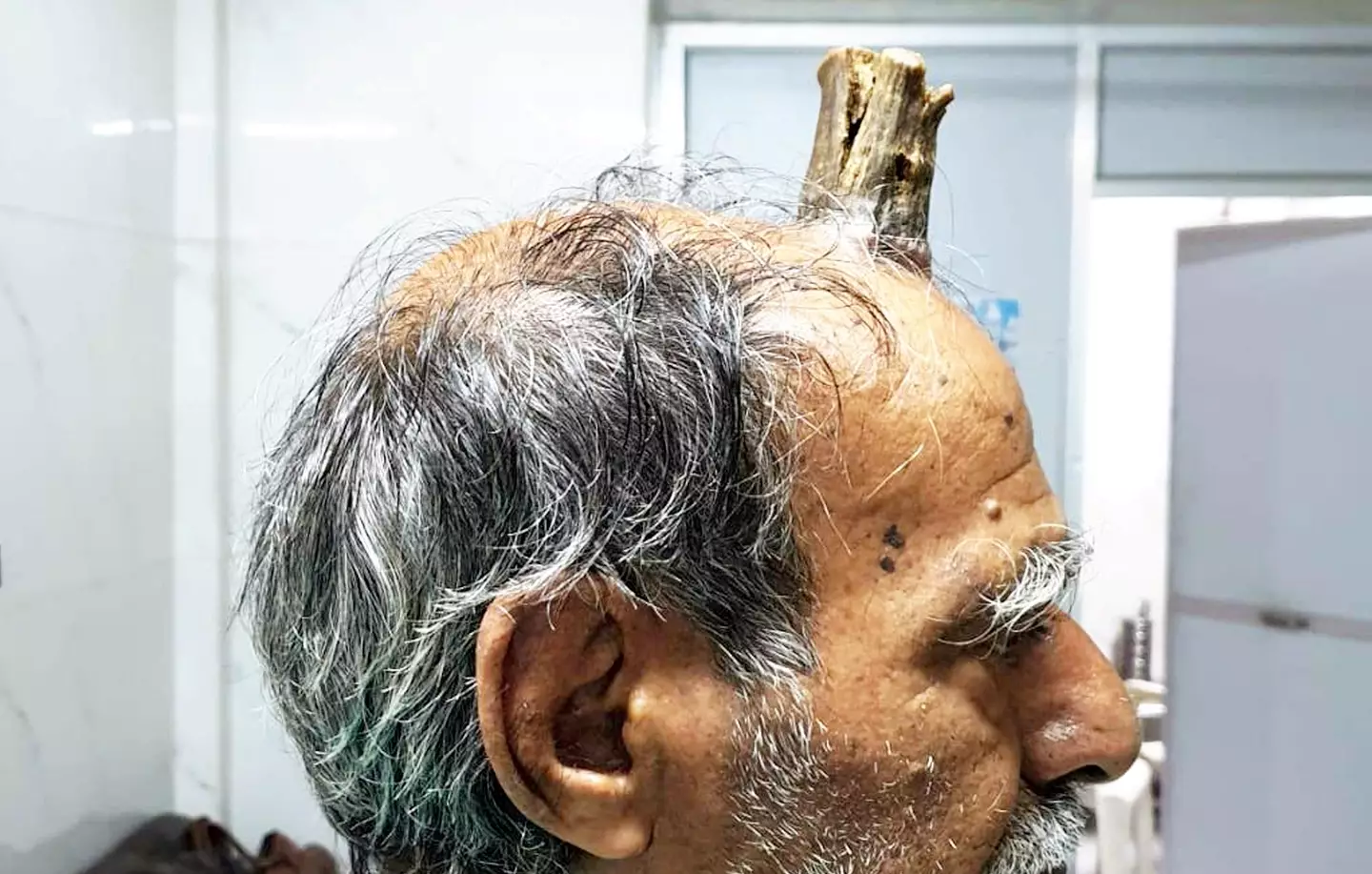 Surgeons were able to remove the growth and graft skin on top. (SWNS)