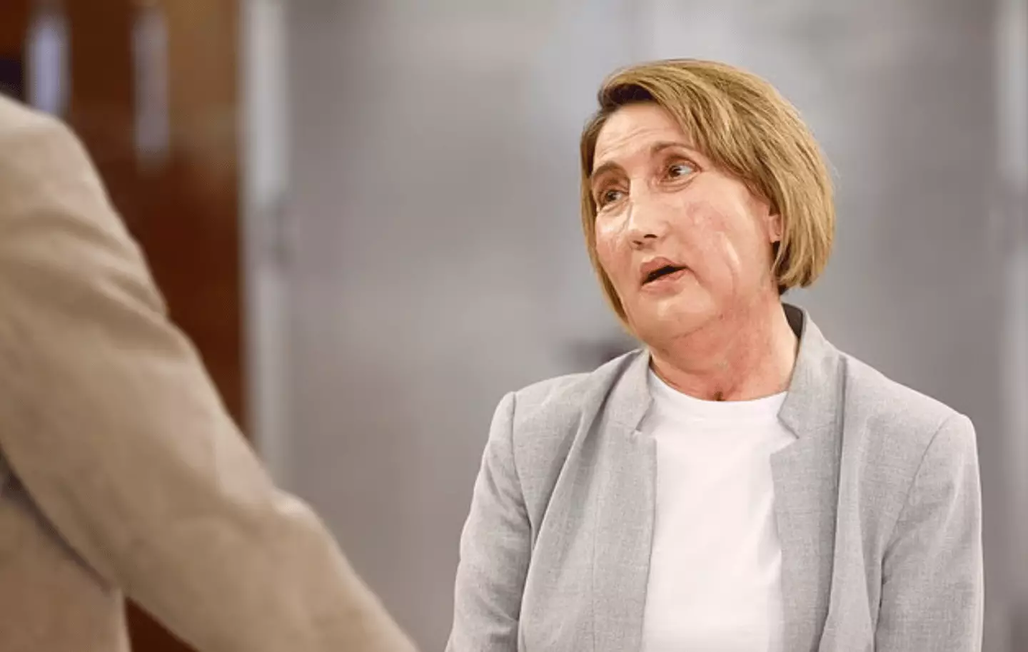 Around 100 healthcare professionals worked on transplanting Carme's new face for close to 24 hours (YouTube/Val d’Hebron)