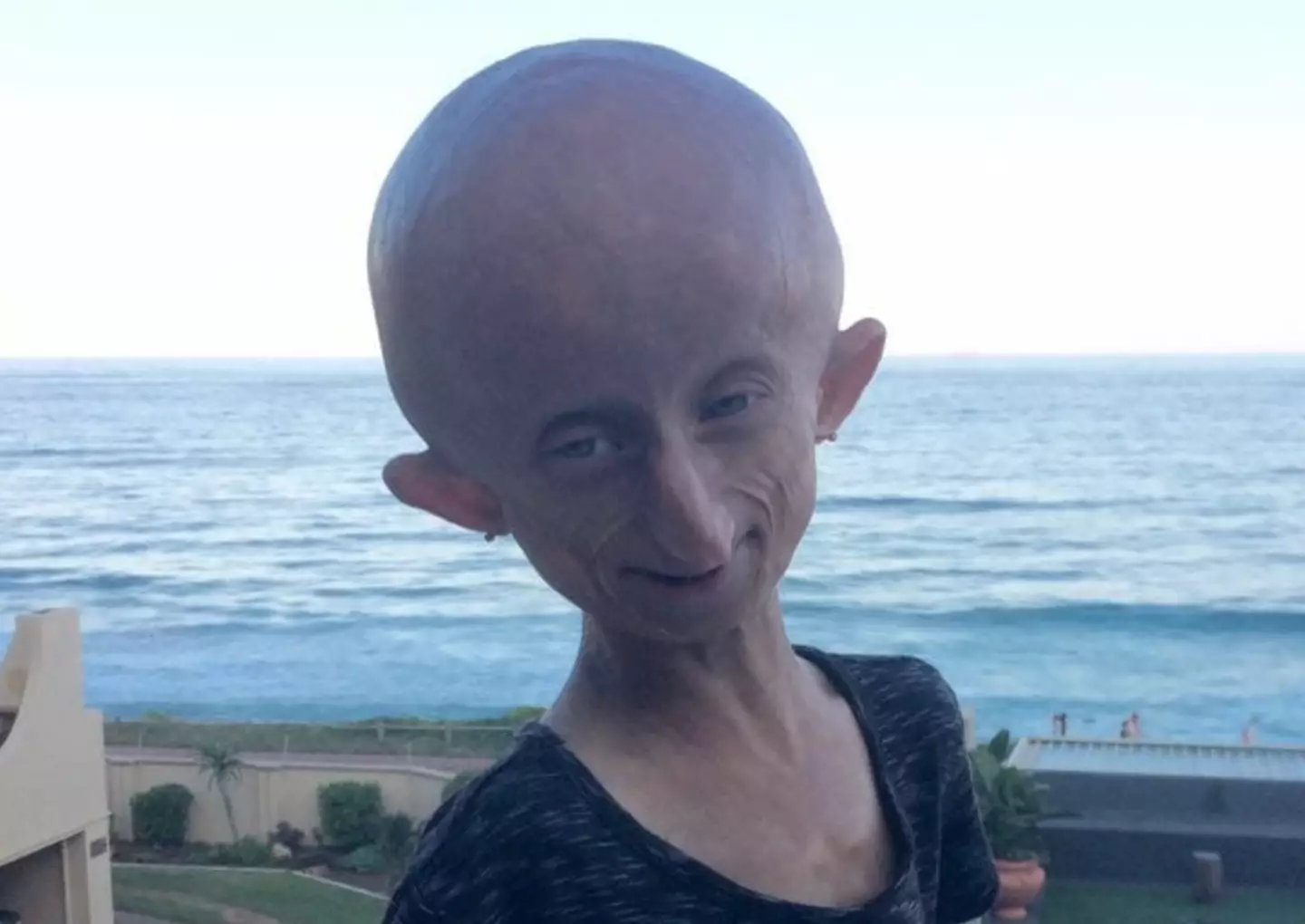 Beandri spoke about her condition on TikTok (Facebook/ Bea Booysen)