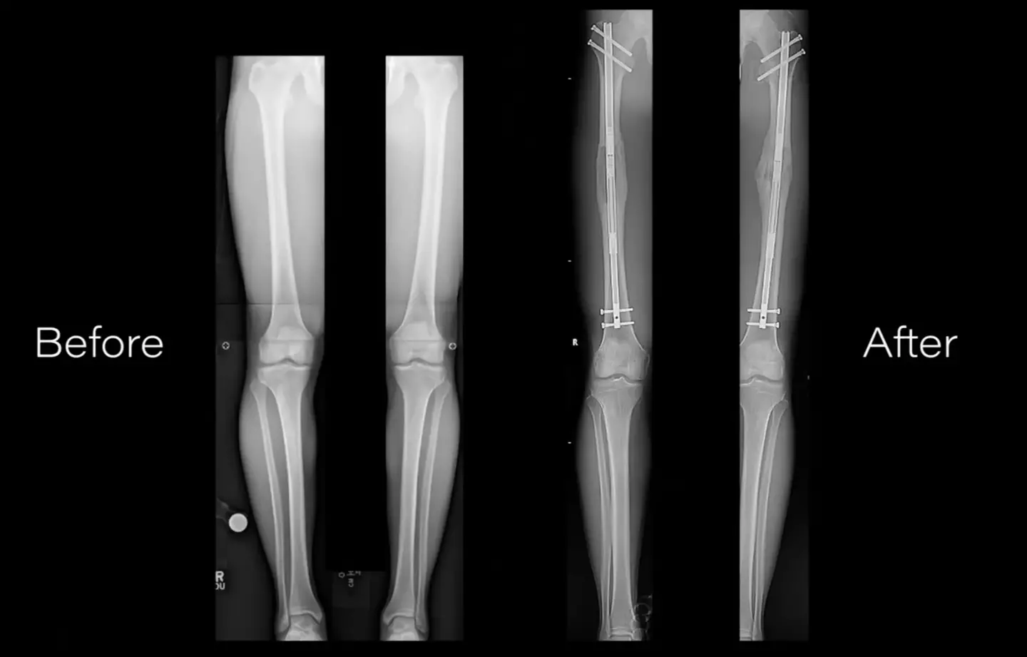 A before and after scan of leg lengthening surgery.