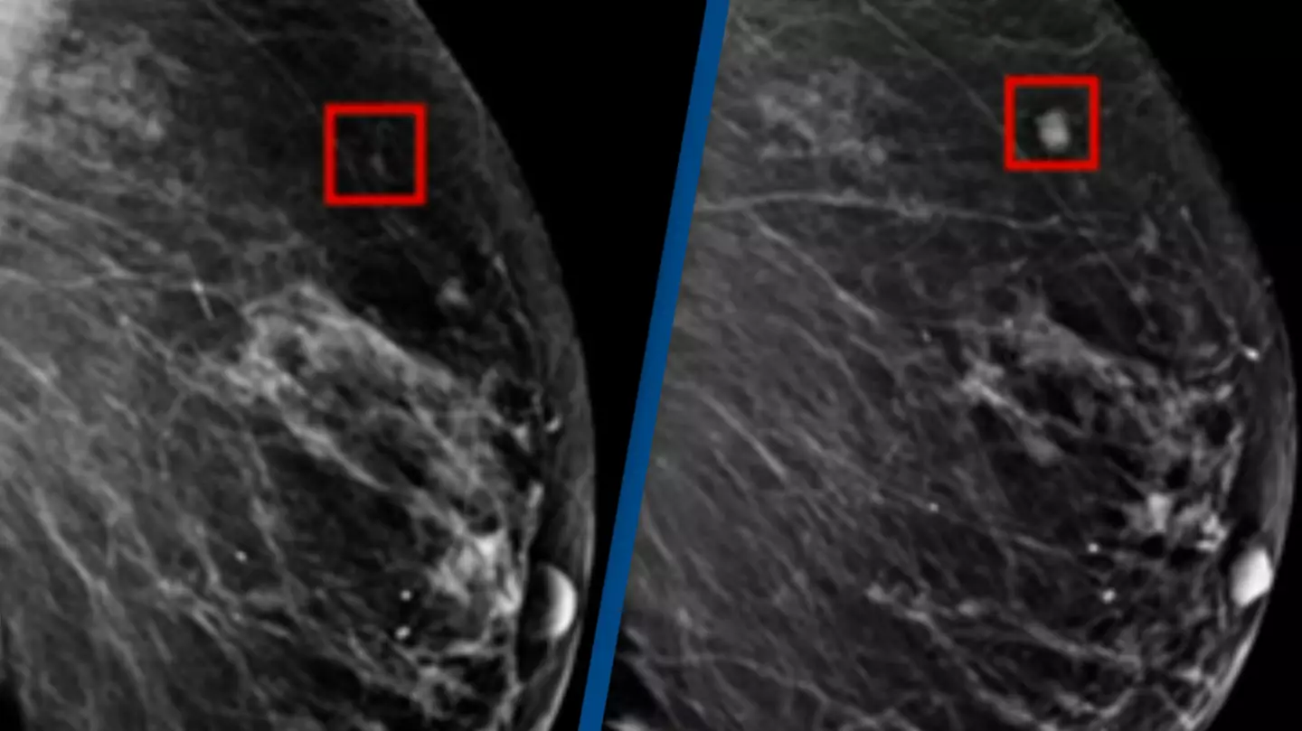 AI detected woman's breast cancer 4 years before it developed