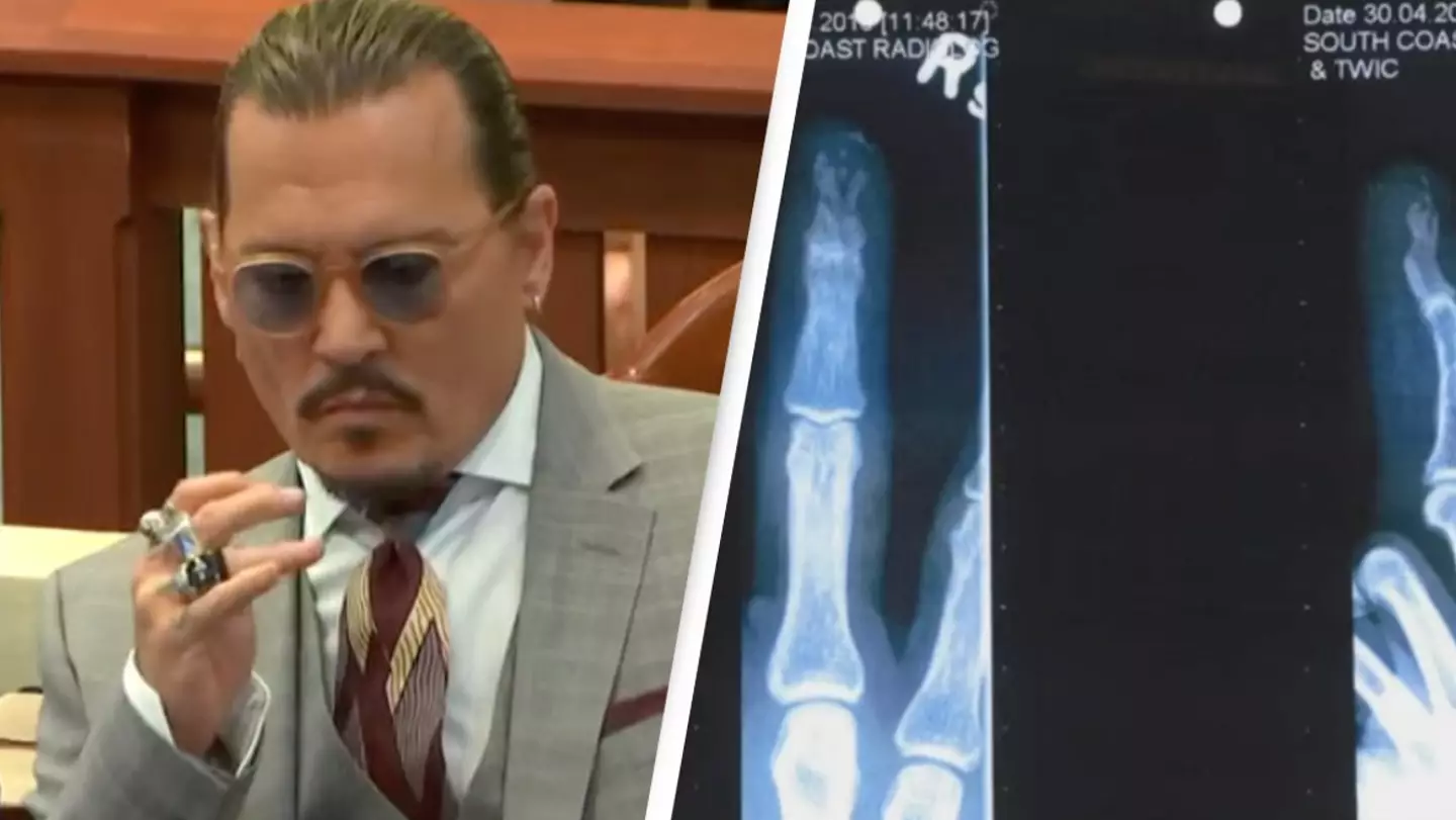 Orthopaedic Surgeon Testifies Amber Heard's Description Of Johnny Depp's Injured Finger Is 'Highly Unlikely'