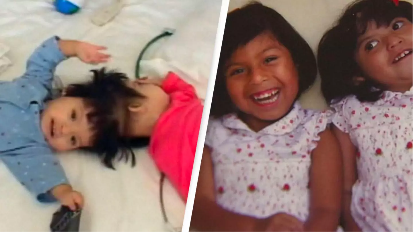 Former conjoined twins celebrate 21st birthday