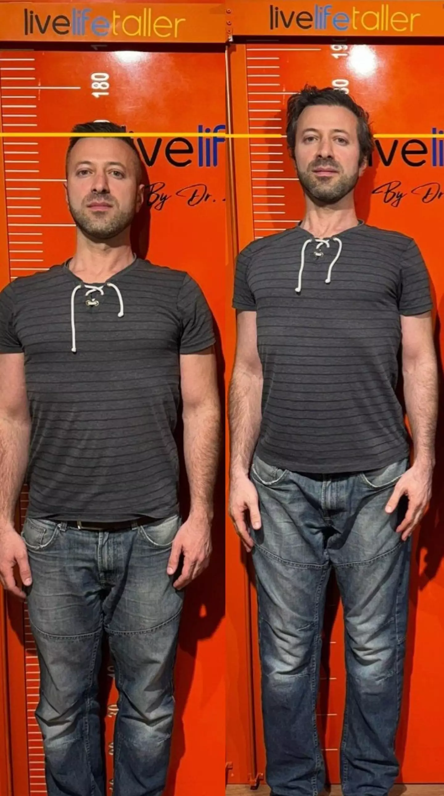 Irakli underwent the surgery to grow 4 more inches (PA Real Life)