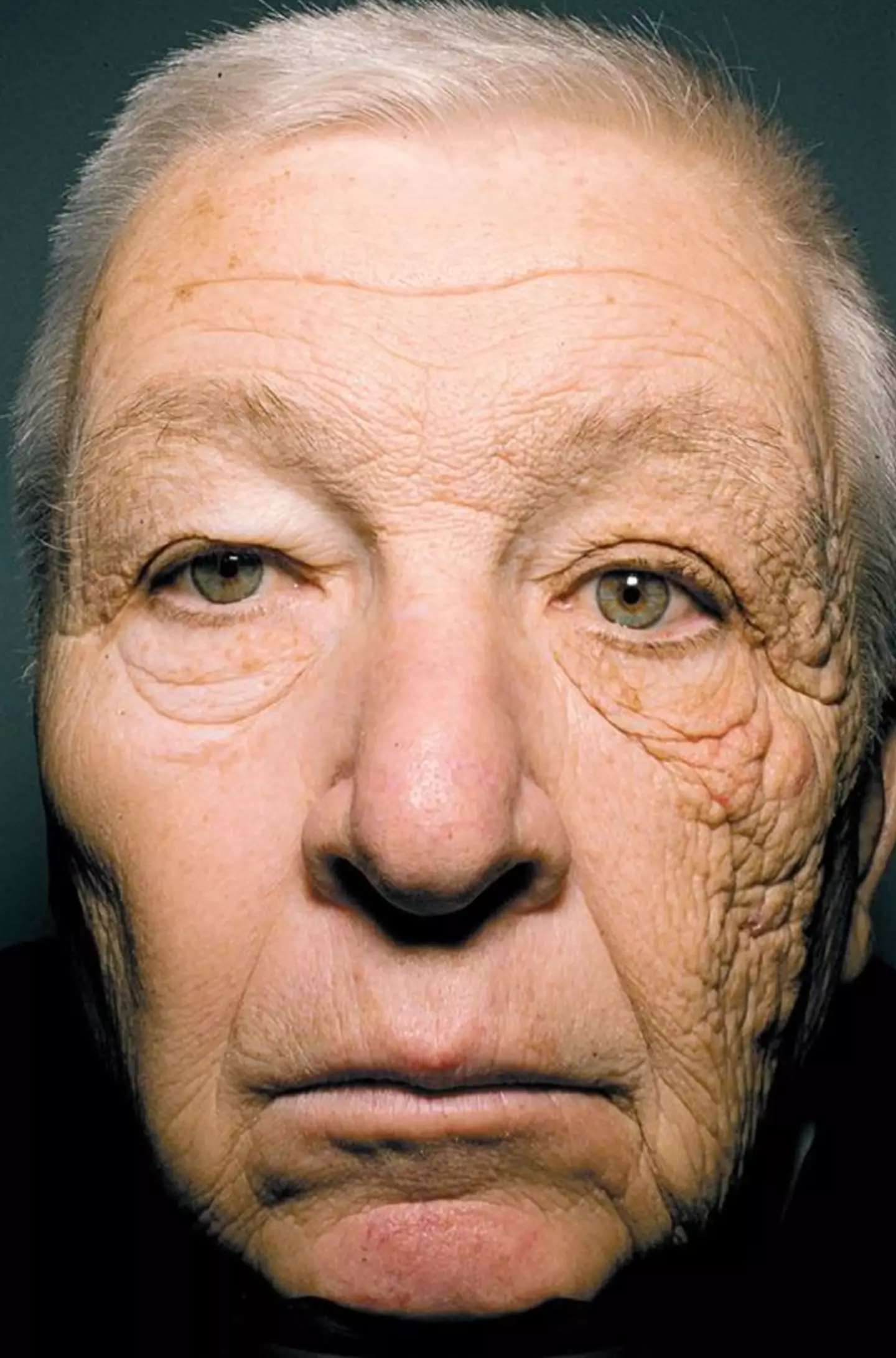 A portrait showing the extent of the sun damage caused to the man's face.