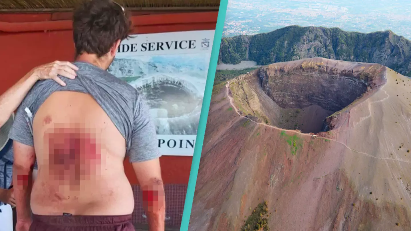 Tourist Shows Off His Injuries After He Fell Into Mount Vesuvius Taking Selfie