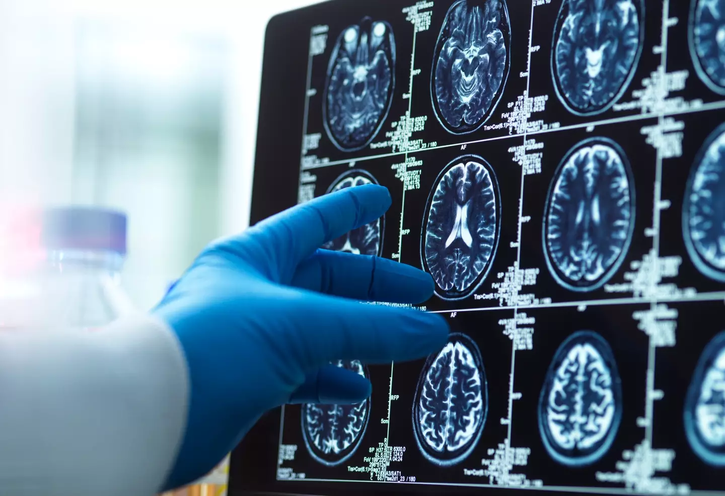A brain bleed is life threatening and requires urgent care (Getty Stock Photo)