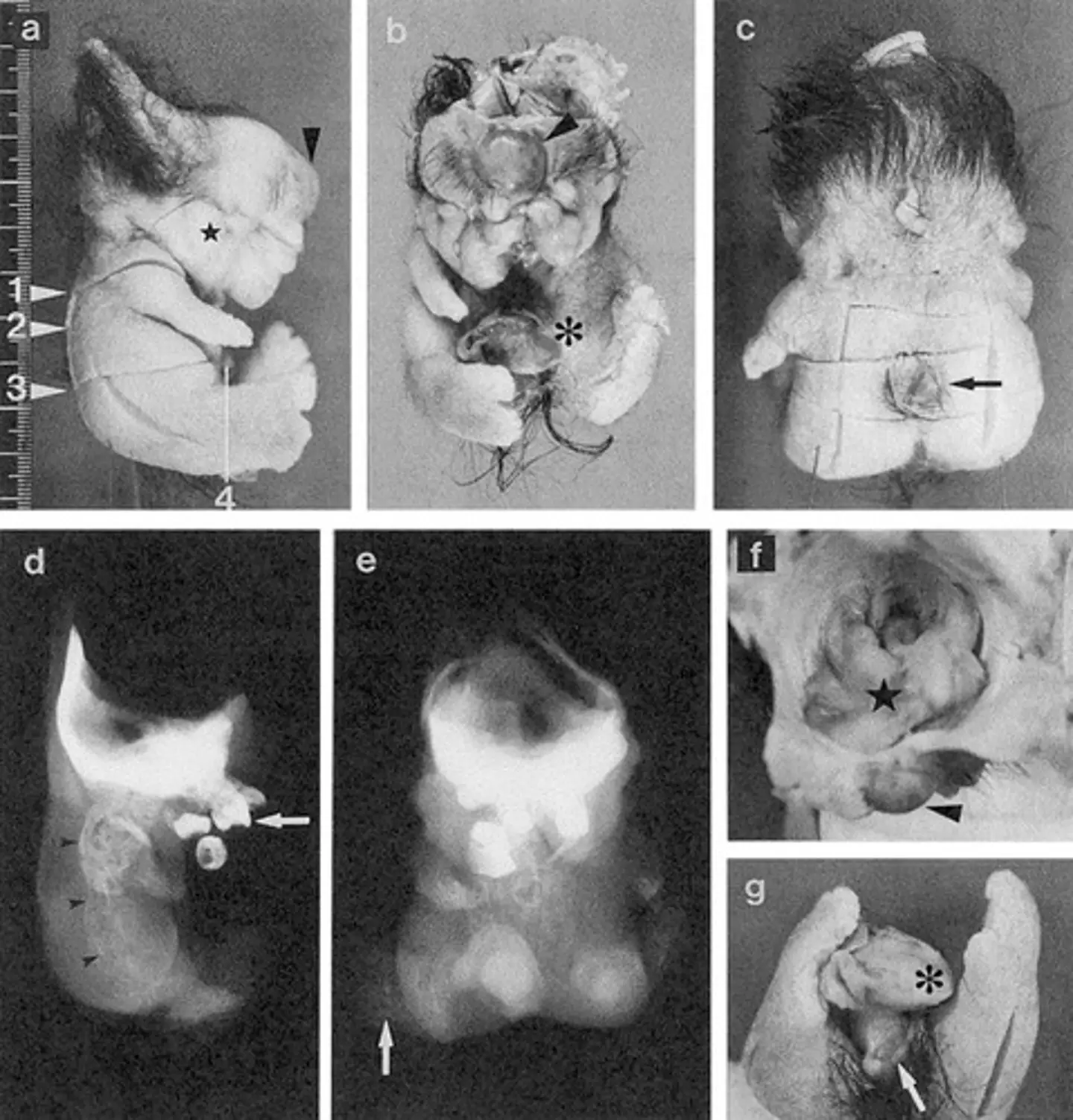 The tumor had a 'doll-like' appearance (Naohiko Kuno, Kenji Kadomatsu, Makoto Nakamura, Takahiko Miwa-Fukuchi, Norio Hirabayashi, Takao Ishizuka)