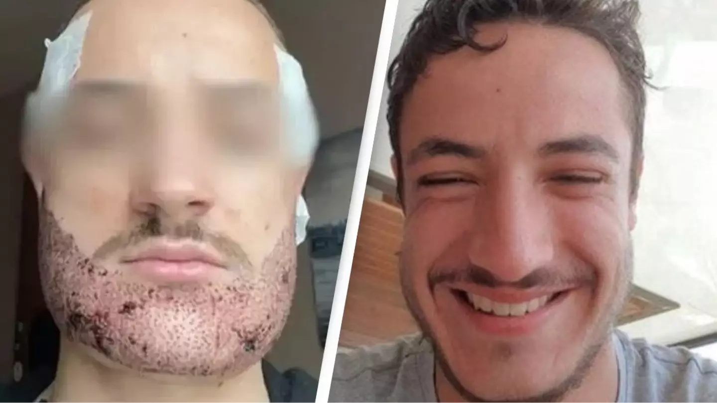 Man dies by suicide after receiving botched beard transplant by 'estate agent posed as a surgeon'