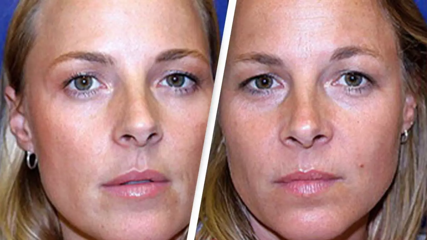 One twin had regular botox for 19 years and the other didn't and this is what happened to both of them