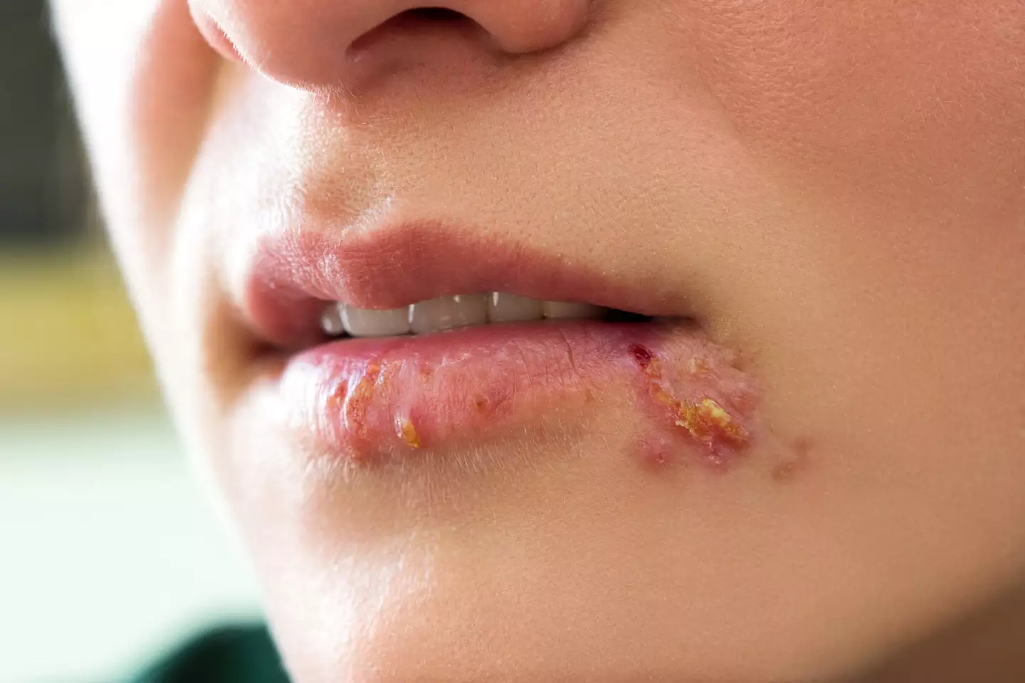 HSV-1, more commonly known as herpes, infects almost two-thirds of the world population (Getty stock)