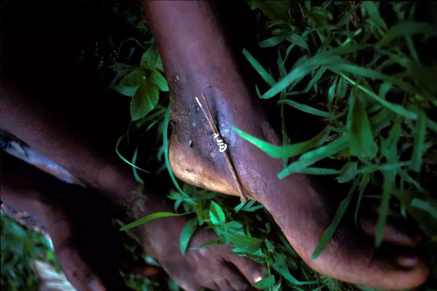 Guinea worm extraction is a gruesome and painful procedure.